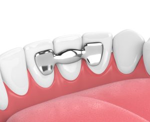 Dental Bridge