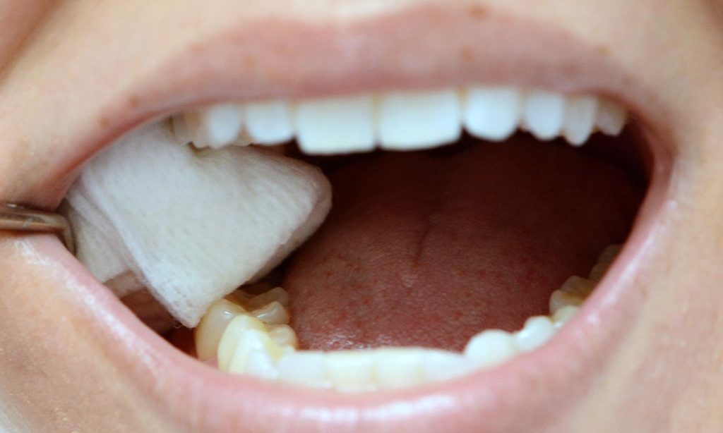 When to Stop Using Gauze After Tooth Extraction