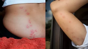 Bed Bug Bites 