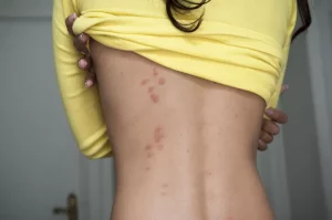 Signs and Symptoms of Bed Bug Bites 