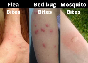 difference_between_flea_bed_bug_mosquito_bites