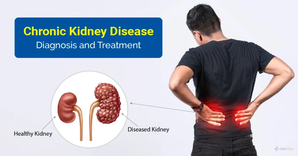 Chronic Kidney Disease – Symptoms, Diagnosis & Treatment