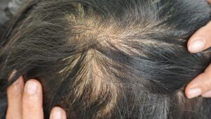 Hair and Scalp Changes