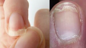 Peeling and cracking of the nails